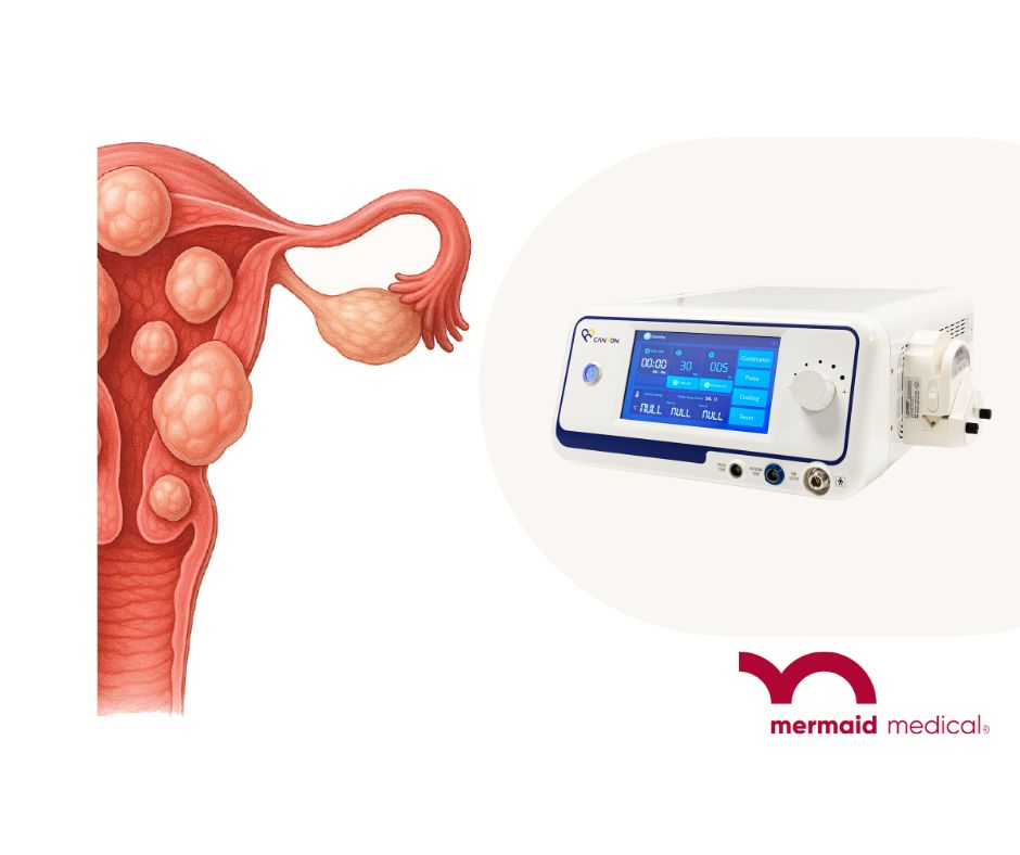 Microwave Ablation for Uterine Fibroids 