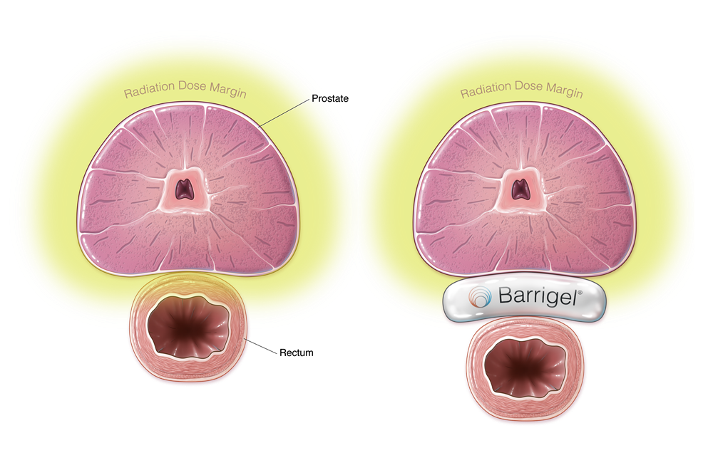 barrigel-rectal-spacing
