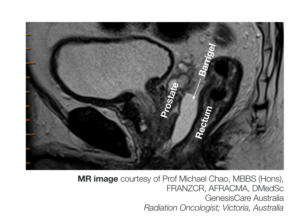 Barrigel® Rectal Spacing